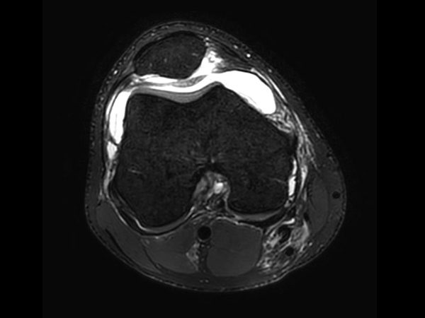 МРТ система Ingenia Ambition 1.5T X может применяться с условно МР-совместимыми имплантатами